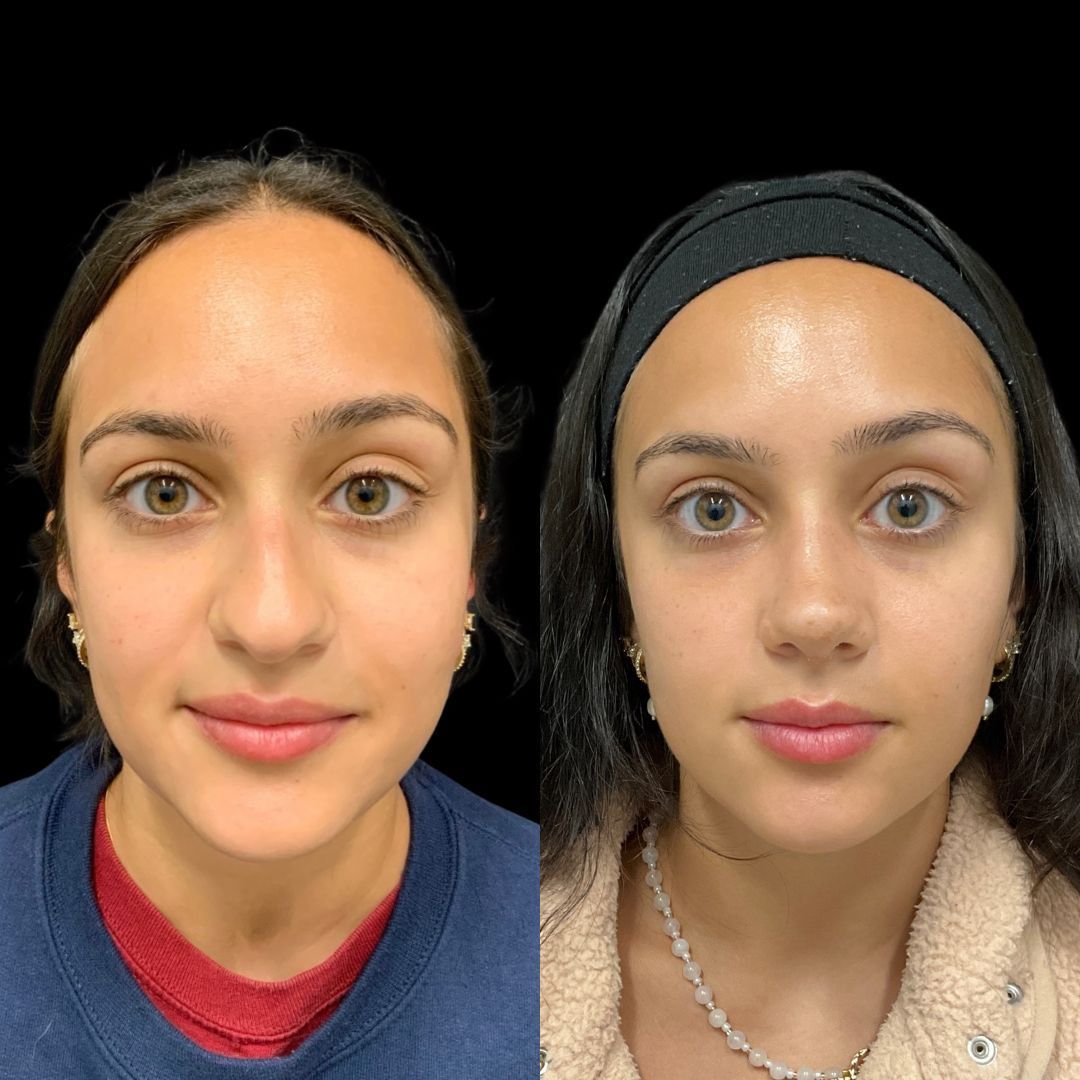 RobbJrMD's tweet image. Meet Taraneh!🤩

⭐️ Taraneh is so, so lovely and naturally gorgeous!

She wanted her nose to fit her face! She did not like her hump and felt it was too big.

These results are at just 1 month post-op — still early healing, still swelling, but already such a harmonious profile!