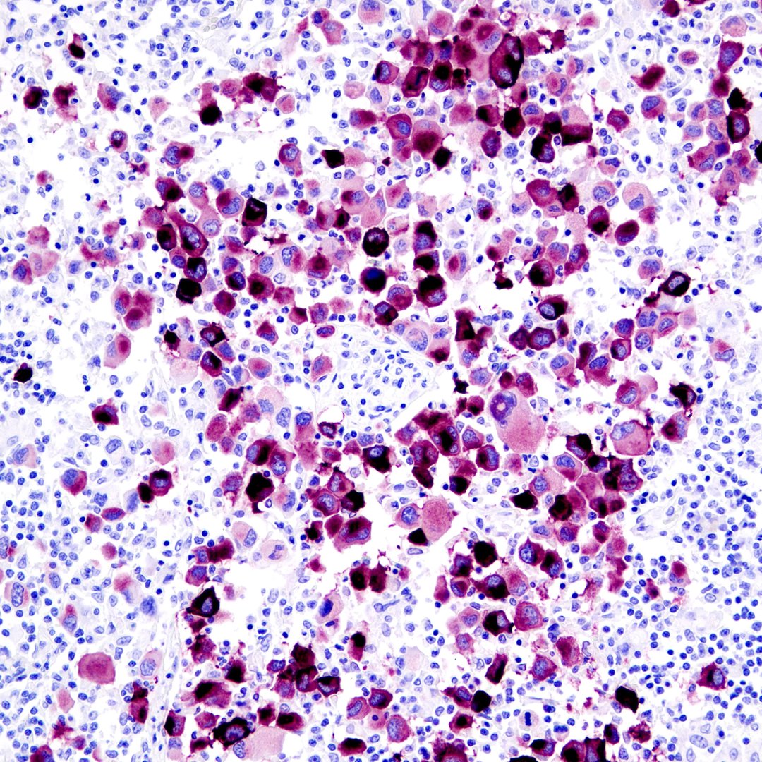 CellSignal's tweet image. Did you know that melanomas have a much higher rate of somatic mutations than other cancers? 

Check out this blog about melanoma-promoting mutations that facilitate tumor growth and survival, many of which are found in the MAPK and PI3K/Akt pathway.

hubs.ly/Q03Lby9W0