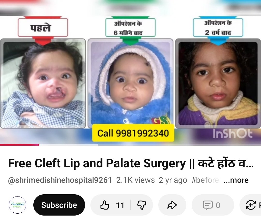 <a href="/Faishal__67/">Faishal</a> <a href="/ankurbjp4india/">Ankur</a> भाई ऐसा है कि अभी पता किया मै रायपुर दिए गए नंबर पर कॉल किया तो बताया कि वजन 5 केजी और तीन महीने होगी तब सर्जरी होता है यहां निःशुल्क और उत्तर प्रदेश साइड भी ऑपरेशन हो जाएगा हॉस्पिटल का नाम बता देगा ये नंबर जो लिखा है फ्री इलाज