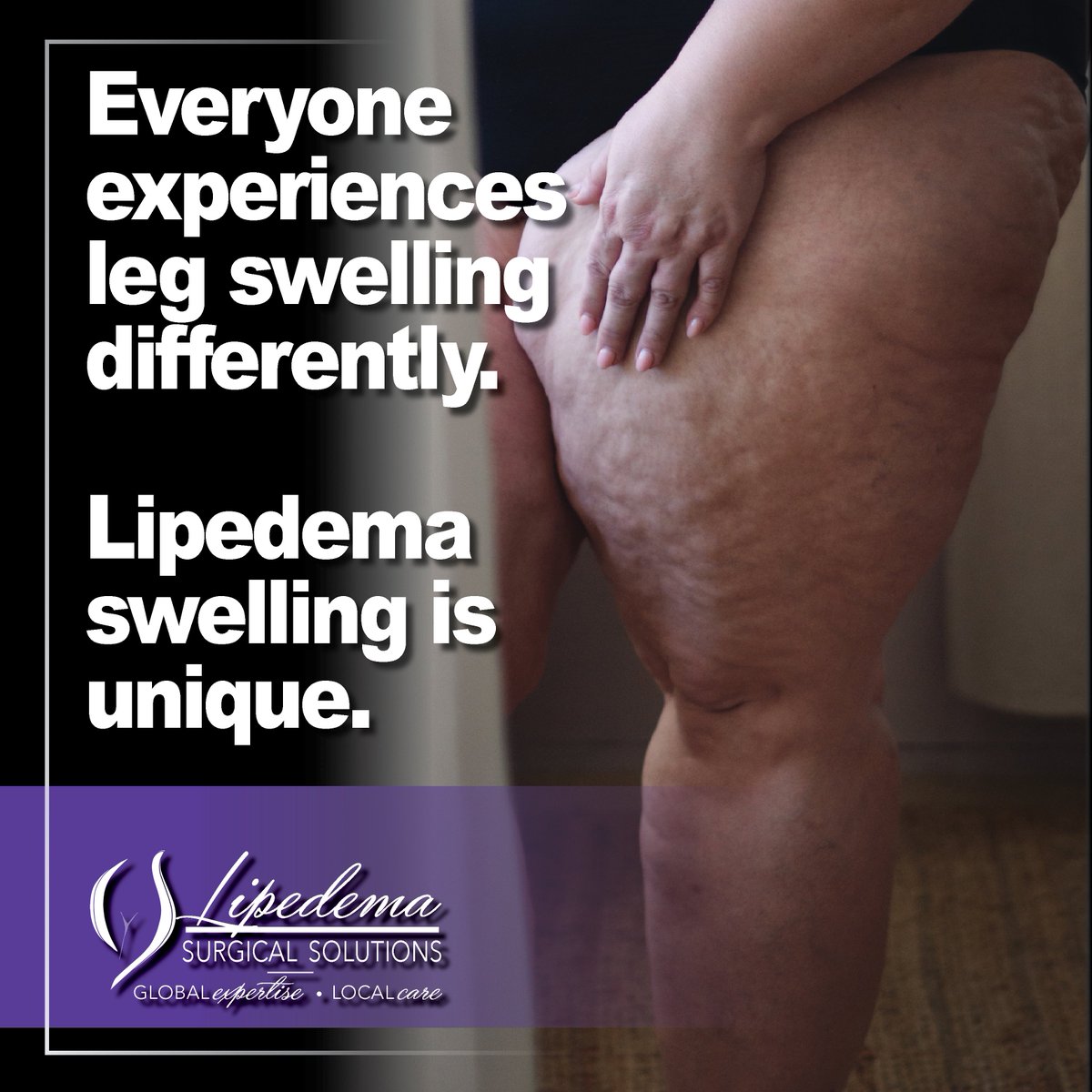 LaserVein's tweet image. 💜 Everyone experiences leg swelling differently. Lipedema swelling is unique—symmetrical, persistent, and often resistant to diet or exercise. Awareness leads to early diagnosis and better care. 💜

#LipedemaAwareness #EarlyDetection #LipedemaSupport