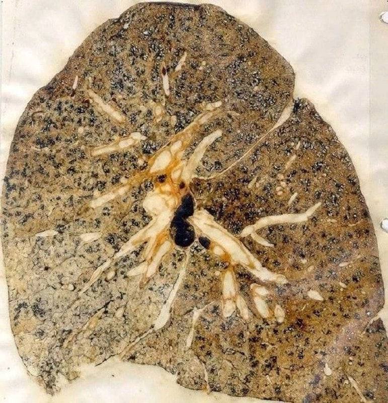 Smart1Doctor1's tweet image. Pneumoconiosis is a chronic lung disease caused by prolonged exposure to industrial dust, in this case organic.
.
.
.
.
#Pneumoconiosis #LungHealth #RespiratoryDiseases #OccupationalHealth #HealthAwareness #ChronicLungDisease #IndustrialDust #HealthEducation #PulmonaryHealth