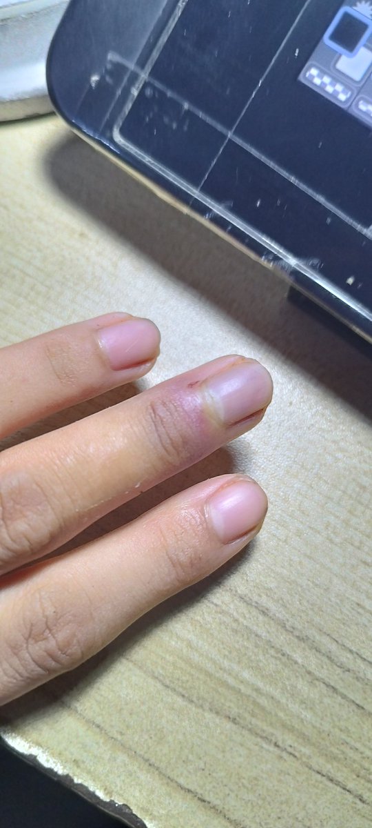 My finger is still hurting but I can now move it. (I hope I didn't break a bone)