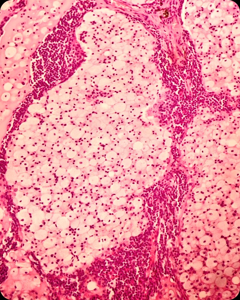 duckhuca's tweet image. 🫁 Lobectomy.
🔬 Post Obstructive Pneumonia.

#LungPath