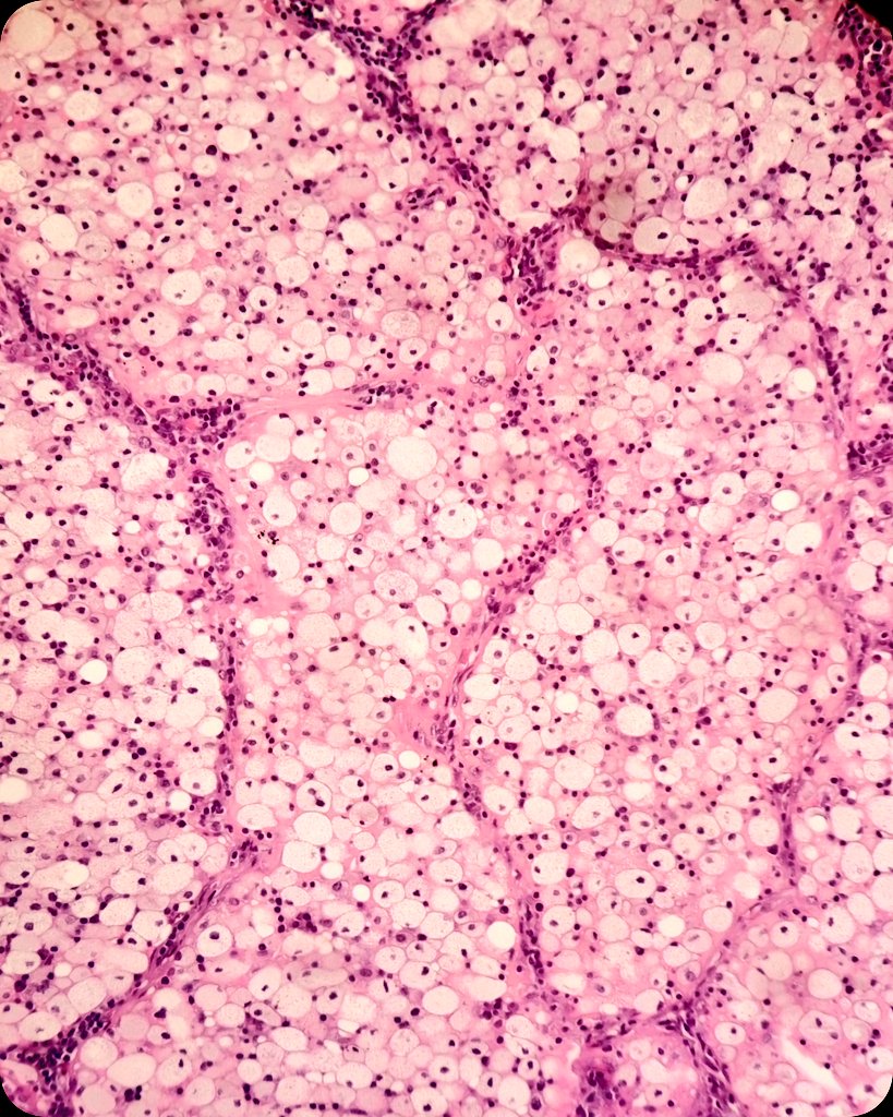 duckhuca's tweet image. 🫁 Lobectomy.
🔬 Post Obstructive Pneumonia.

#LungPath