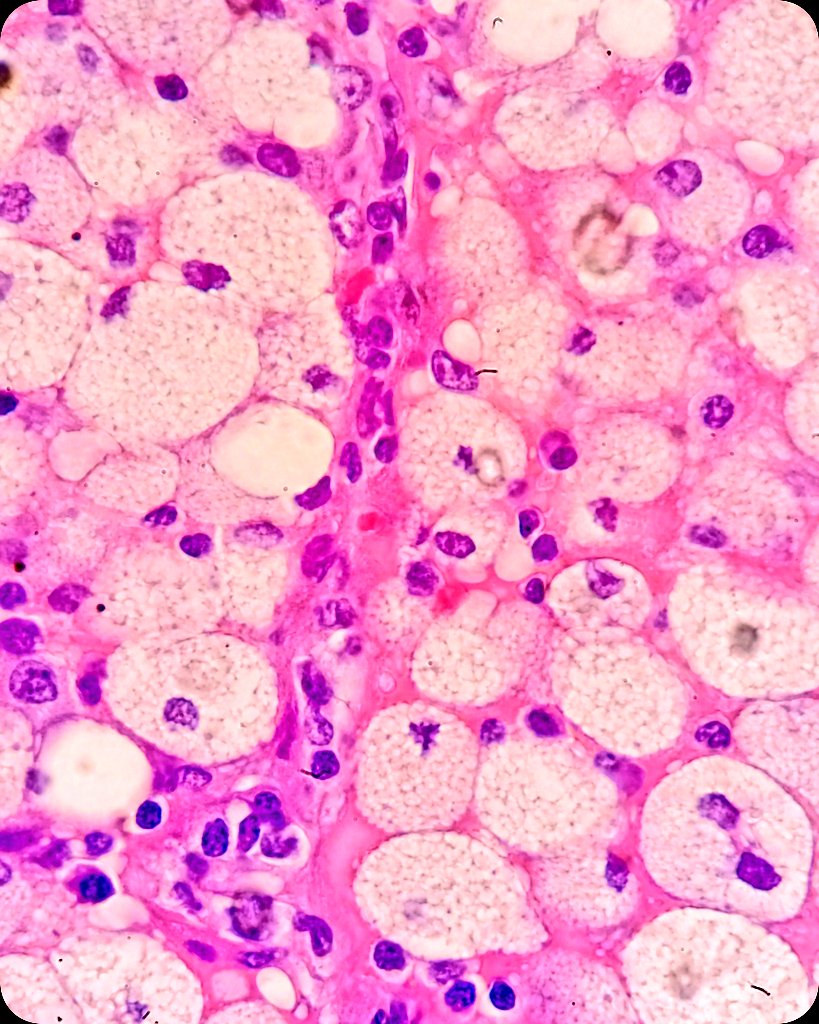 duckhuca's tweet image. 🫁 Lobectomy.
🔬 Post Obstructive Pneumonia.

#LungPath