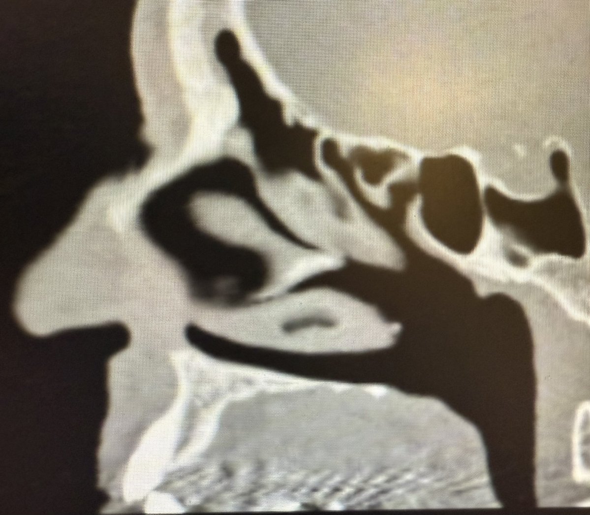 First 2 pics pre-extractions, scope: +++ pus. Next 2 pics 6 months post-extractions and recent abx course, scope: scant pus. Think it will finish resolving? Pt feels good, so leaving alone (for now). Maybe we’ll publish on this topic in 2026? <a href="/ent_ams/">Alberto Maria Saibene, MD, MA</a> <a href="/MartaKwiat_ska/">Marta Kwiatkowska, MD, PhD</a> <a href="/MakaryENT/">Chadi Makary, MD, MSc</a>
