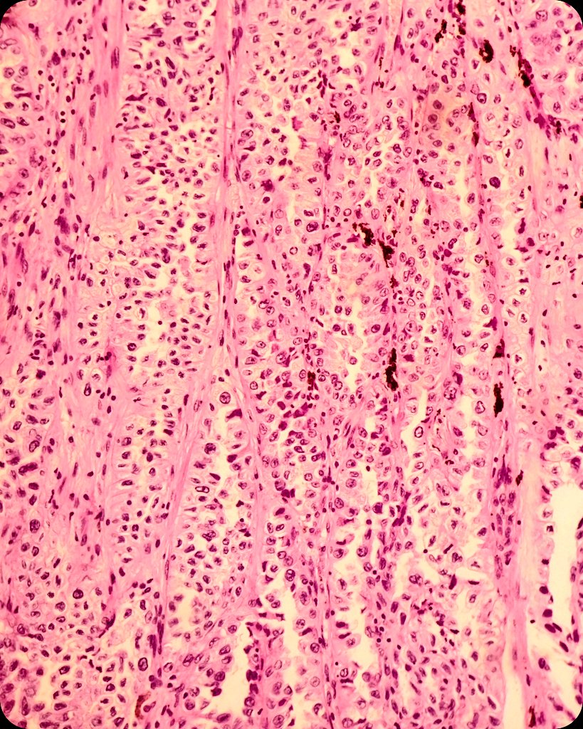 duckhuca's tweet image. 🫁 Lobectomy.
🔬 Lung Adenocarcinoma.  Papillary Pattern.

#LungPath #LungCancer.