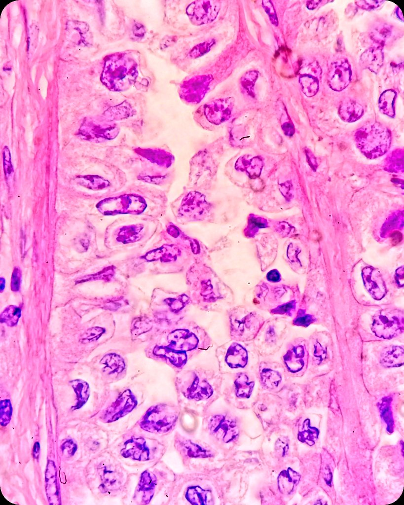 duckhuca's tweet image. 🫁 Lobectomy.
🔬 Lung Adenocarcinoma.  Papillary Pattern.

#LungPath #LungCancer.