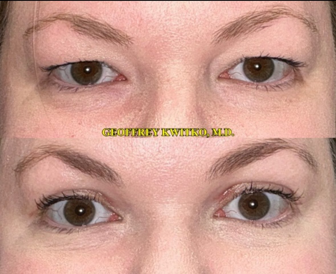 Perfect natural results. Dr Kwitko Tampa’s most experienced eyelid surgeon by a mile. 📲813-877-8665