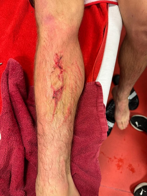 Roland Sallai'nin ayağının son durumu.