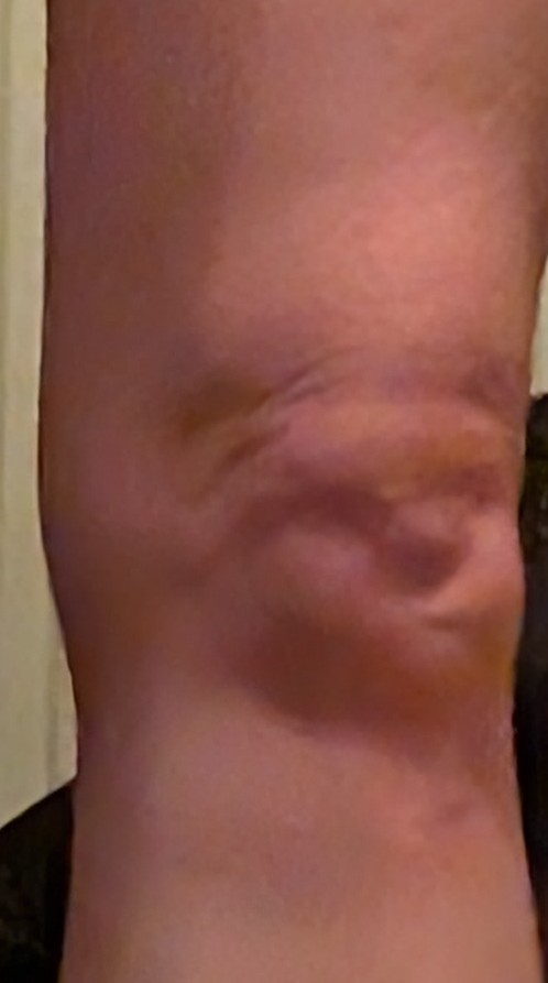 Err guys. Why does my knee look like a Rembrandt self portrait?