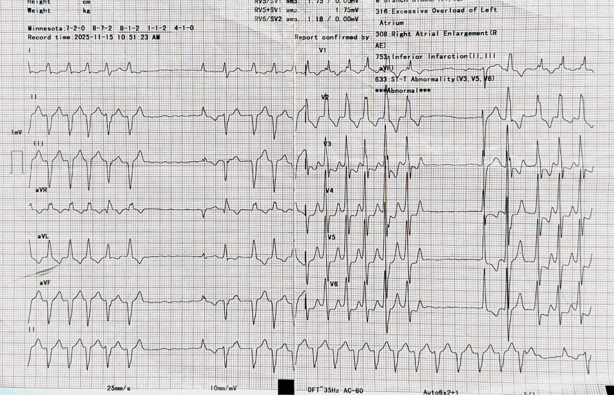 DrRajeshG1's tweet image. ECG for fellows, Your opinion? Zoom and see