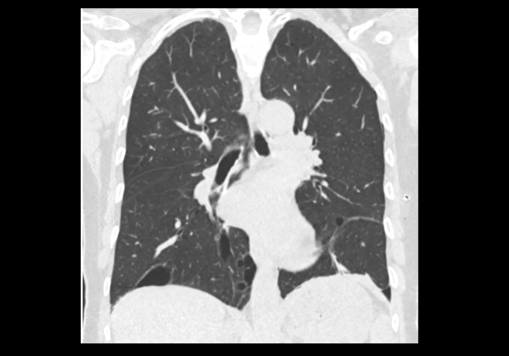 ehealthmgmt's tweet image. Accurate tracking of early-stage lung adenocarcinoma just levelled up 🧠🫁
RadioTrace uses #deeplearning + CT #radiomics to map continuous tumour progression &amp;amp; predict outcomes more precisely than traditional grading.
Read more: iii.hm/1y5a
@npjDigitalMed  #LungCancer
