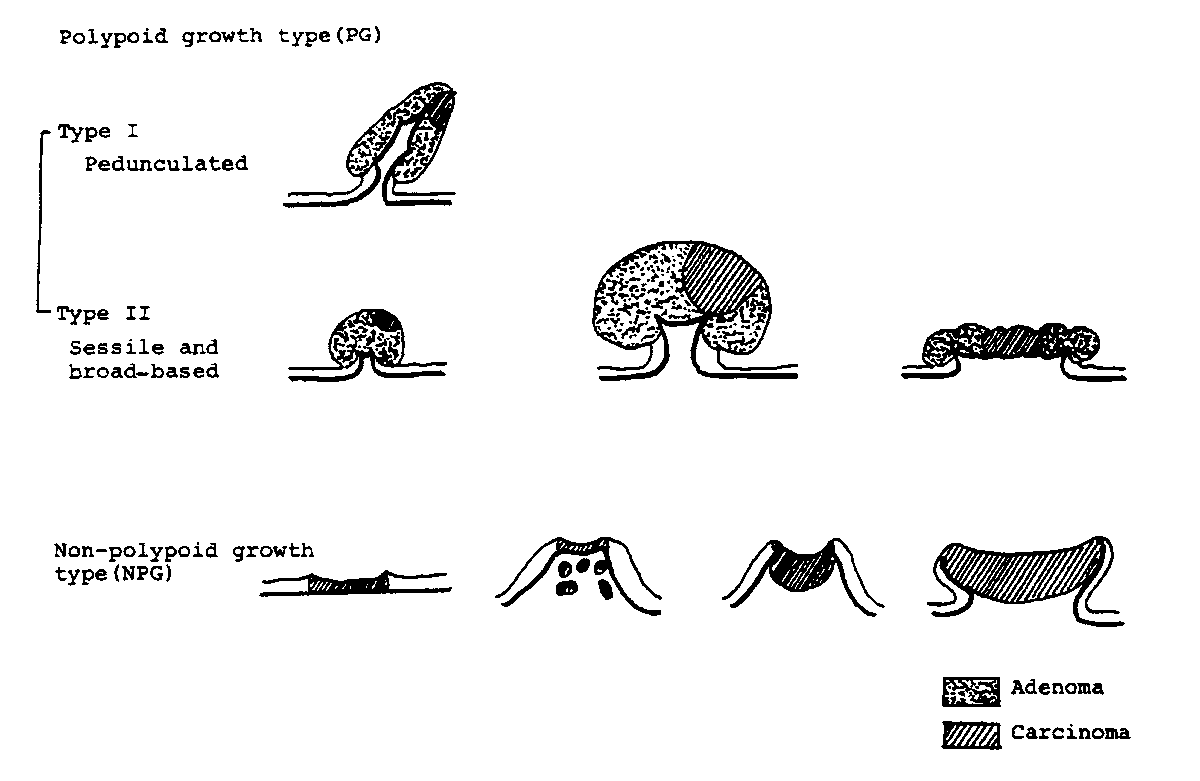 jocamaga1974's tweet image. Have you tried using @NanoBanana to update images from older articles and improve medical illustrations for your presentations? 
Here is an example on de novo CRC in non-polypoid growth lesions, based on the article by Shimoda T. et al., published in Cancer in 1989 👇