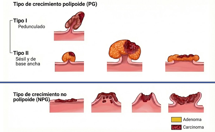 jocamaga1974's tweet image. Have you tried using @NanoBanana to update images from older articles and improve medical illustrations for your presentations? 
Here is an example on de novo CRC in non-polypoid growth lesions, based on the article by Shimoda T. et al., published in Cancer in 1989 👇