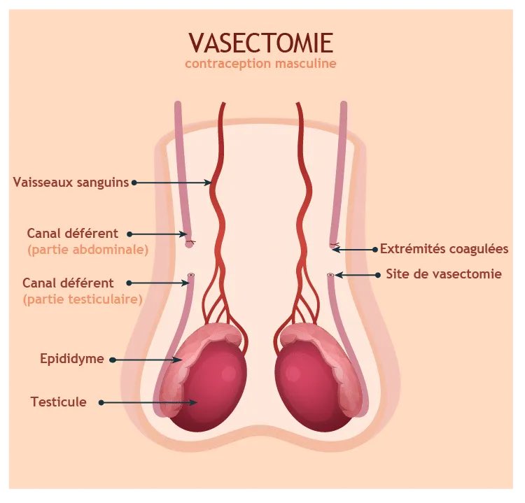 Il est l’heure de lâcher un thread explicatif d’utilité publique sur la vasectomie parce que t’auras beau mettre un pied dans une crèche géante, tu verras jamais plus de pleureuses que les hommes sur Twitter quand il s’agit de ce sujet (tabou et incompris) ⬇️⬇️⬇️ (sources en bas)