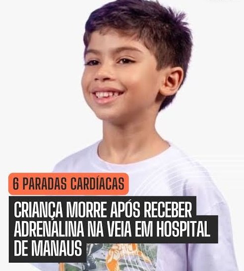 MiguelCat14's tweet photo. Uma criança com laringite recebe adrenalina pura na veia. Não nebulização. Não diluída. Pura. E ninguém ao redor, absolutamente ninguém, achou estranho?

É impossível não se indignar.
Mesmo quem não é médico sabe que adrenalina é uma droga de impacto imediato, usada em situações de vida ou morte. A ideia de aplicar 3 ml, três vezes, por via endovenosa, numa criança de 6 anos, deveria ter acendido todos os alarmes da equipe.

E é justamente isso que mais choca: não é um detalhe técnico, não é parâmetro avançado, não é nuance de especialidade. É o básico do básico. É o tipo de coisa que qualquer profissional minimamente atento questionaria na hora.

Como uma prescrição tão absurda passa da médica, passa pela farmácia interna, passa pela enfermagem e chega à veia de uma criança?
Como ninguém interrompe o procedimento?
Como ninguém levanta a mão e diz: "Desculpa, isso aqui não faz sentido"?

Não estou a falar de culpa individual, e sim de algo que parece ainda pior: falta de cultura de segurança.
Um ambiente onde decisões são seguidas no automático, onde doses incompatíveis com a vida não geram sequer uma dúvida — esse ambiente é um risco por si só.

O erro de um profissional é possível. Mas o silêncio de toda uma equipe é inaceitável.
E quando uma criança morre por algo que qualquer pessoa leiga já acharia estranho, então existe algo profundamente errado no sistema, não apenas no gesto final.

Uma tragédia dessas não pode ser normalizada. E muito menos repetida.