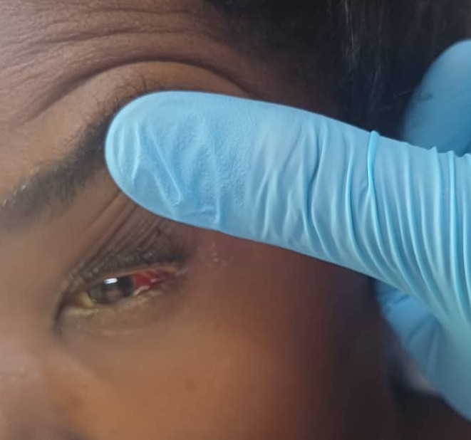 rkalyes1's tweet image. 🏥 26yr/F with fever and headache comes in very sick.
🔥 She was well until  1 wk ago with no known chronic illness history 
👉 Please review the images and the labs.
🔥 What is going on?
🔥 How do we save her?

@DrOribaDan 
@ChefKarim02 
@DrAkhilX 
@TSM_Humanist 
@DennisPhd1