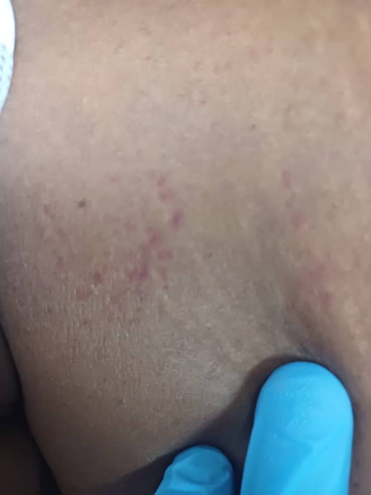 rkalyes1's tweet image. 🏥 26yr/F with fever and headache comes in very sick.
🔥 She was well until  1 wk ago with no known chronic illness history 
👉 Please review the images and the labs.
🔥 What is going on?
🔥 How do we save her?

@DrOribaDan 
@ChefKarim02 
@DrAkhilX 
@TSM_Humanist 
@DennisPhd1