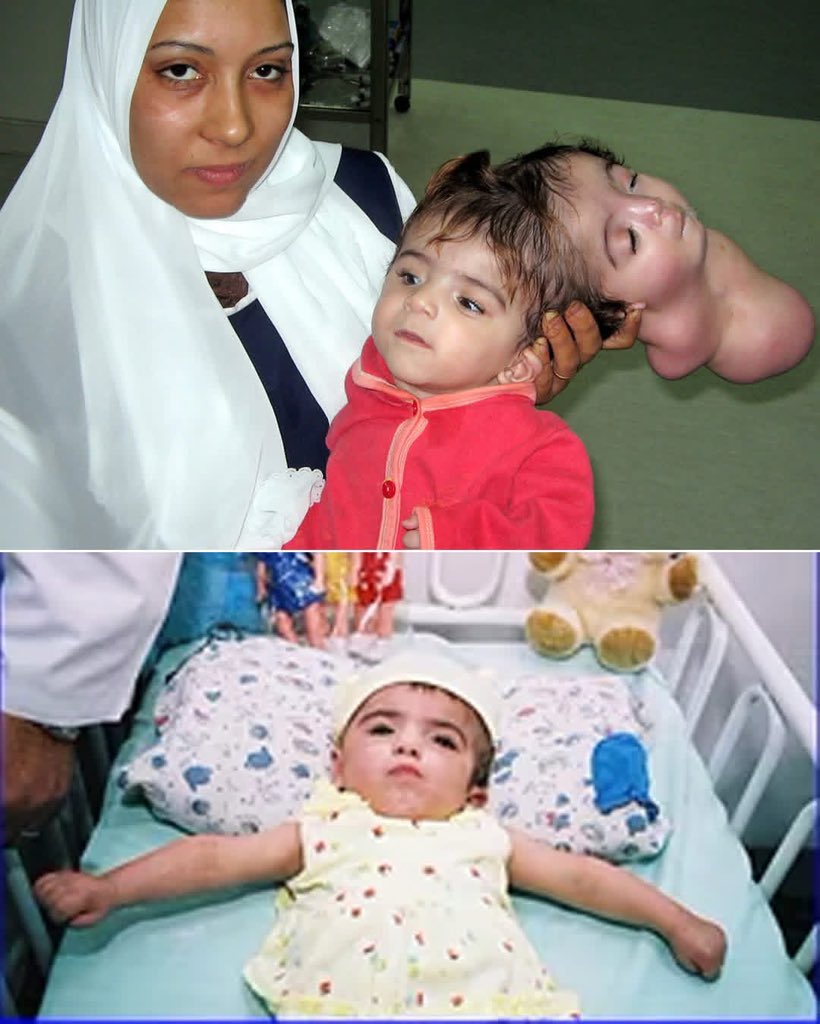 history_inimage's tweet image. The Baby Who Carried Two Lives in One — and Changed Medical History Forever
In 2004, in a small Egyptian town, a baby girl named Manar Maged came into the world with one of the rarest conditions ever seen. 
Attached to her tiny skull was a second head — a parasitic twin that