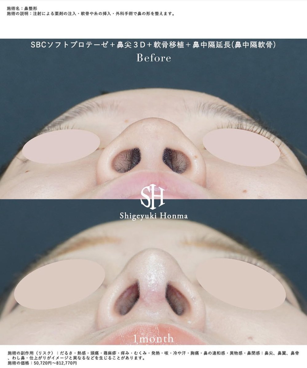 本当にこの通り。

小鼻と頬の間の溝は鼻翼溝(ナゾラビアルフォールド)と呼ばれますが、自然な鼻には必ずこれがあります。

小鼻縮小による過剰切除により鼻翼溝が消失すると、いかにも整形感のある不自然な鼻になります。

整形＝不自然な鼻
ではなく、整形により「自然で美しい鼻」にする事が重要。