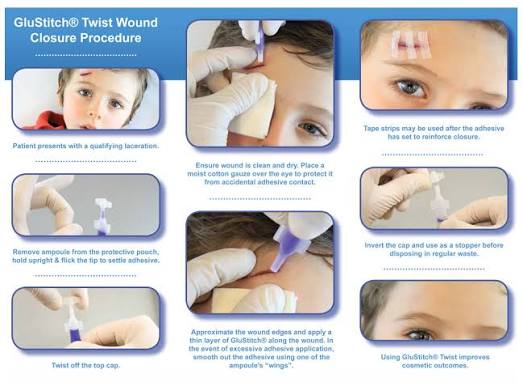 GridDefence's tweet image. There is a medical grade glue available, the doctor might have used it and the family might have thought it was Fevikwik.🤣
medical-grade cyanoacrylate (like Dermabond) is commonly used to seal minor skin wounds as an alternative to stitches—it&apos;s sterile, fast, reduces scarring.