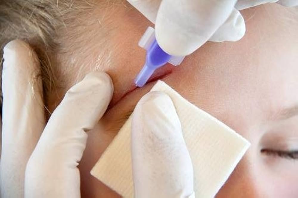 GridDefence's tweet image. There is a medical grade glue available, the doctor might have used it and the family might have thought it was Fevikwik.🤣
medical-grade cyanoacrylate (like Dermabond) is commonly used to seal minor skin wounds as an alternative to stitches—it&apos;s sterile, fast, reduces scarring.