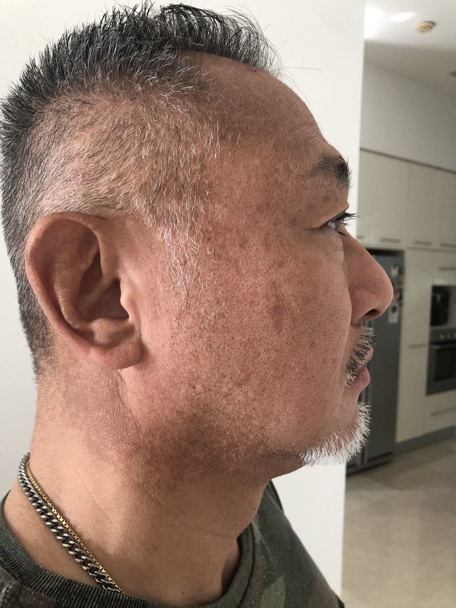 この投稿するか悩んだのですが、感想は皆さんの判断に任せます🤔　他にも写真あります... 詳細と現在の状況についてもっと知りたい方は PMにて🧐
#マレーシア　#美容　#シミほくろ