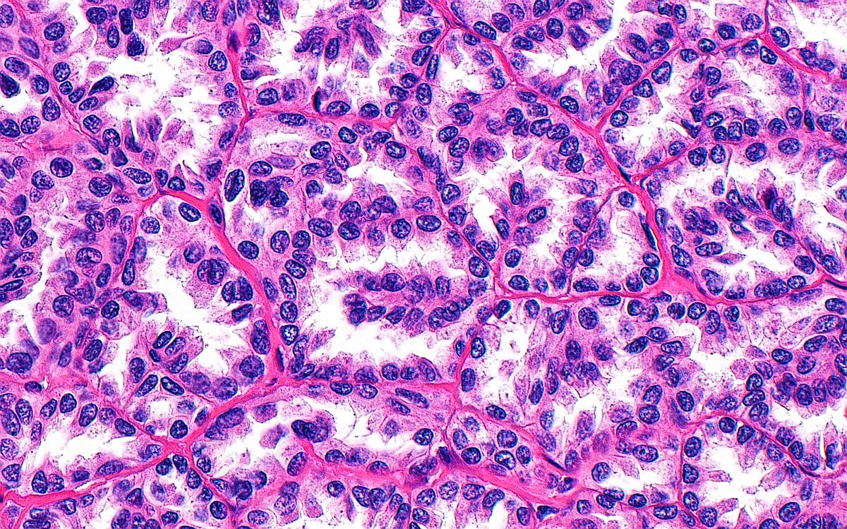 ziad_zaatari's tweet image. 🔬📸 Papillary Renal Cell Carcinoma ~ Tubular architecture in a papillary RCC ~ #GUpath #Pathology #Kidney #PathArt