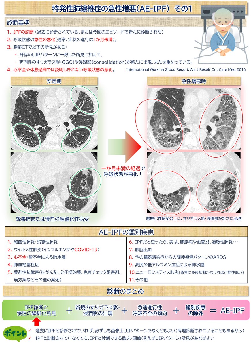 lungdrnote's tweet image. 🫁11/22の 【症例クイズ79歳男性】の解答です。

①最も鑑別の上位に挙がる病態は？
過去に特発性肺線維症（IPF）とは診断されていませんが...

1）過去または今回のCTで両下肺野の胸膜下優位の網状影・牽引性気管支拡張・蜂巣肺→UIPパターン…