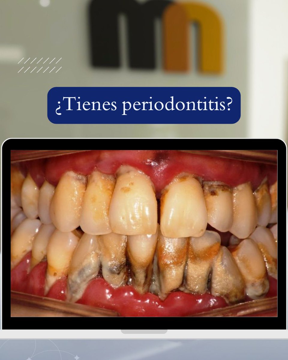 ClinicaMN's tweet photo. 🦷 Encías rojas, inflamadas o sangrado al cepillarte pueden ser señales de gingivitis o periodontitis. Detectarlo a tiempo evita la pérdida dental. En Clínica Martínez Navarro te ayudamos a detectar el problema a tiempo. 
ℹ️ https://t.co/zE4XHmlmvO
📞 Pide cita: 952402000 https://t.co/WTxBoOpIKQ
