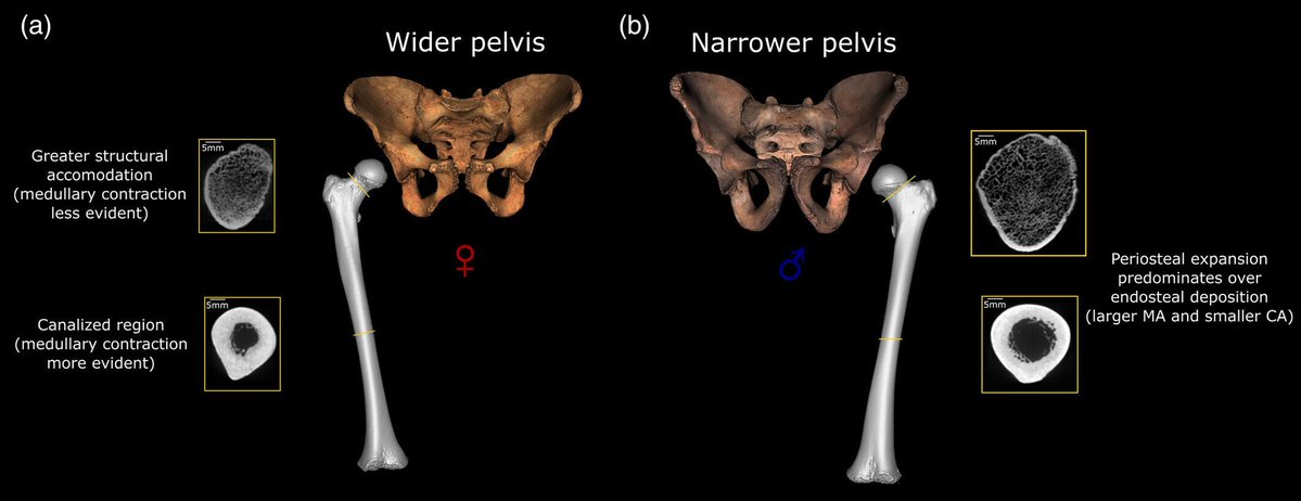 🦴 New study reveals how teen growth and puberty shape the femur from inside out.
Analyzing medieval femora, researchers found sex-specific “medullary contractions”  during adolescence—especially in females &amp; varying by region
Muñoz-Guarinos et al.: anatomypubs.onlinelibrary.wiley.com/doi/10.1002/ar…
