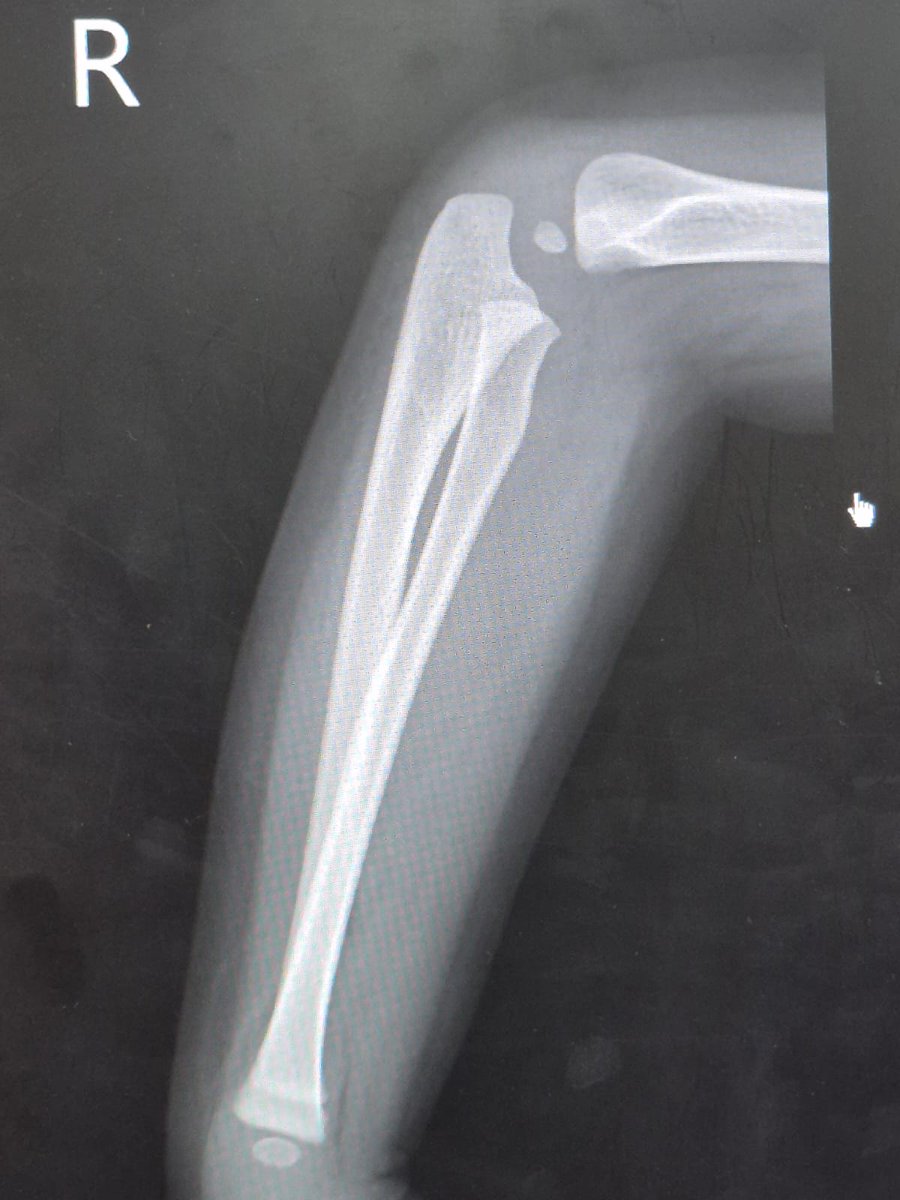 Got in the morning from some meetings and my youngest child managed to fling herself off the bed and started screaming bloody murder. Her arm was visibly bent...so off to the hospital we go. 

Turns out, kids bones can just bend. The doctor just massaged it around to straighten
