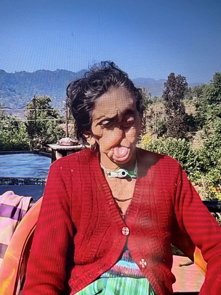 student_forevr's tweet photo. जब किसी जानवर का हमला होता है तब बहुत ब्रेकिंग न्यूज़  बनती है लेकिन उसके बाद सब भूल जाते है

यह घटना  29 अप्रैल 2007 गढ़वाल की है
कमला देवी (8534063565) पर भालू ने हमला किया था
2 साल दिल्ली इलाज चला और आज  भी liquid diet  पर है

पहाड़ी बस वोट बैंक है और कुछ नहीं 💔
#Uttarakhand https://t.co/LlUeYtaAXT