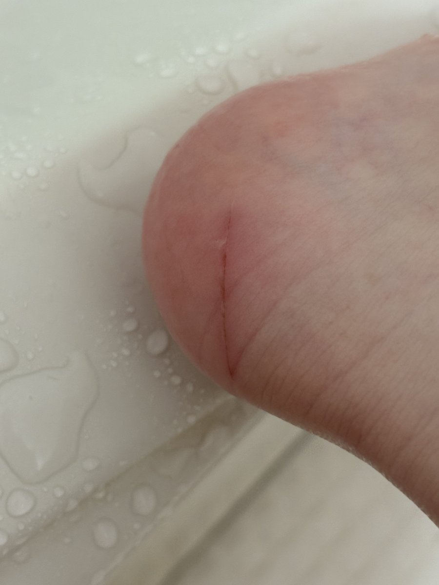 hayaoki_u_u's tweet image. かかとがかなりの大怪我してるඉ́  ̫ ඉ̀
何これなんの怪我なのඉ́  ̫ ඉ̀