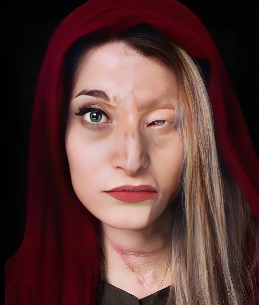 viviapostat's tweet image. Par déni de réalité, des musulmans crient au fake sur cette photo. 

Elle s’appelle Marziyeh Ebrahimi, attaquée à l’acide pour ne pas avoir mis le voile.