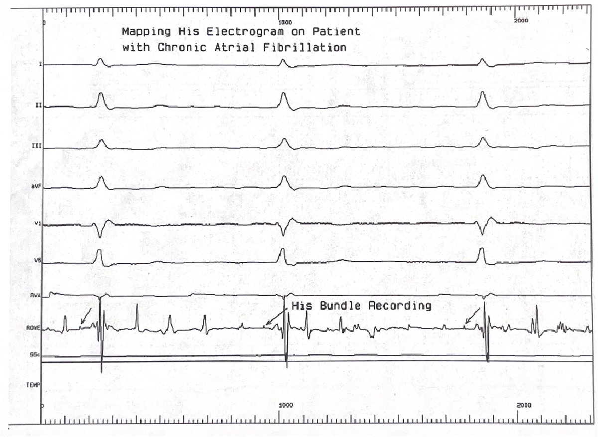 ChartAcademy's tweet image. 💥Join the yearly GROW membership BEFORE11/30-FREE-ExPloring EP course Feb &apos;26!
📆 link in bio!

🎒 EP Study
1. AVN RFA with ppm provides which of the following:
1. rate control
2. rate regularity
3. rate responsiveness
4. all of the above

#CHARTpeeps #EPeeps #VivaEP #CHARTEPPro