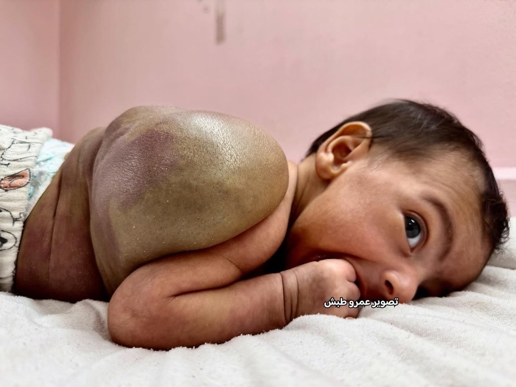 ⚠️⚠️⚠️
Baby Habiba Ridwan, one month, was born with this large blood ball in a Gaza hospital..

To save her life, she needs urgent treatment abroad..

The only way for her to travel for treatment is the opening of the Rafah Crossing which is being closed by the Israeli occupation