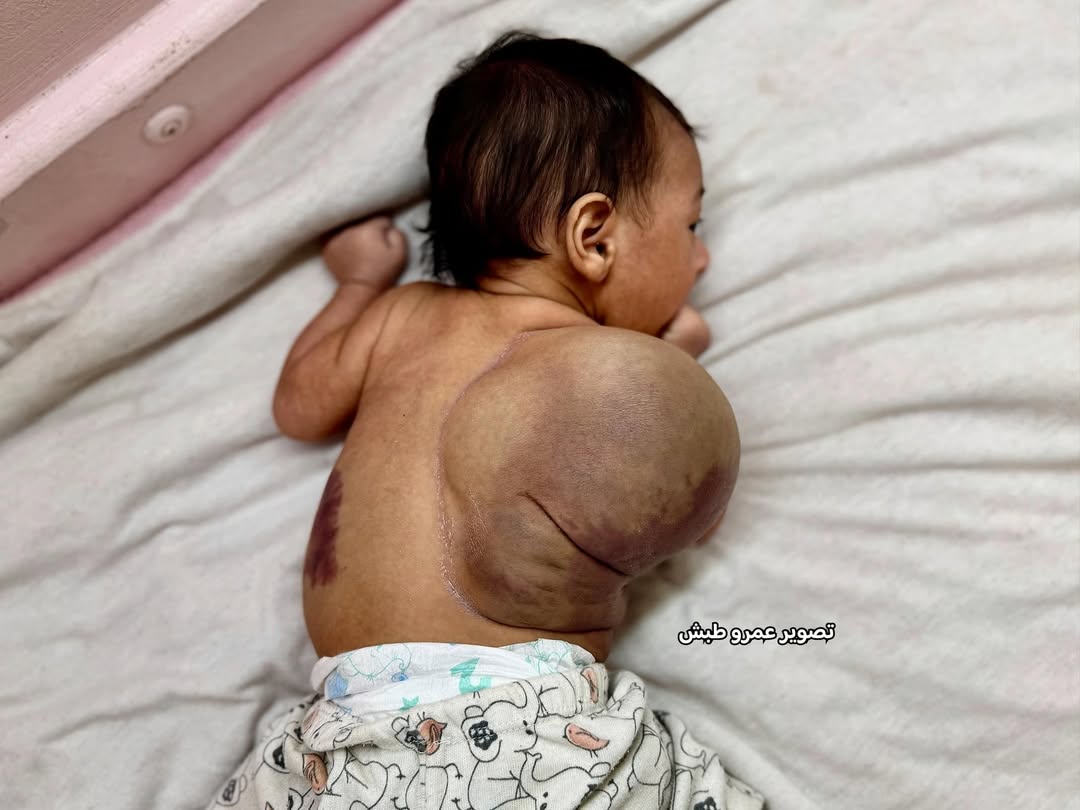 Timesofgaza's tweet image. One-month-old Habiba Abu Radwan has a fast-growing blood cyst that threatens her life. No treatment is available in Gaza. She urgently needs to travel for life-saving surgery… every minute counts.