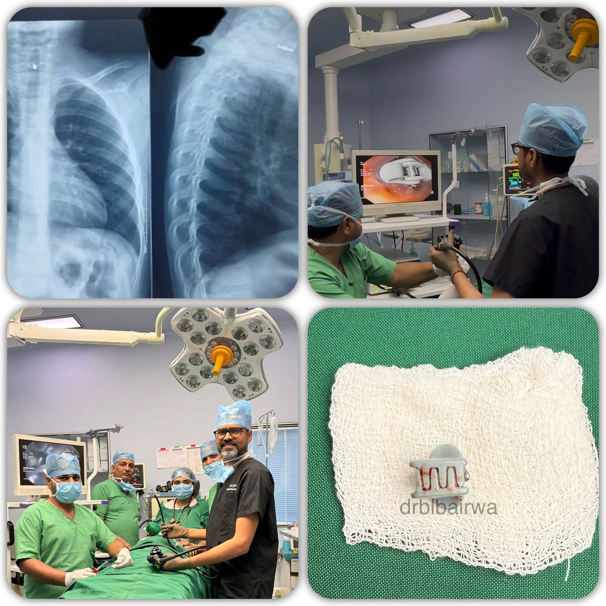 Lap_surgeon's tweet image. आज एक 3 साल की बच्ची की Oesophagus (ग्रासनली) से फँसा हुआ hair butterfly clutcher दूरबीन द्वारा निकाला गया।

बच्चों का ध्यान रखे, ये सब बहुत घातक हो सकता है।🙏
#sunday