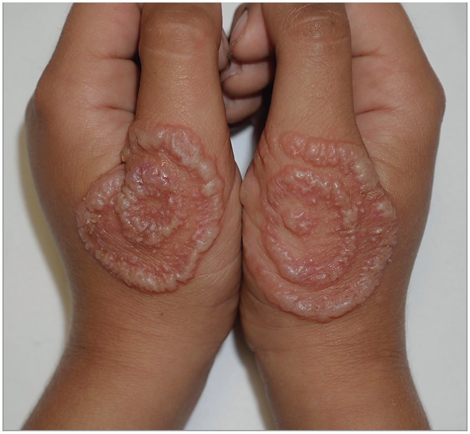 drkeithsiau's tweet image. Unusual appearance seen on the hands of a child. What’s the diagnosis?