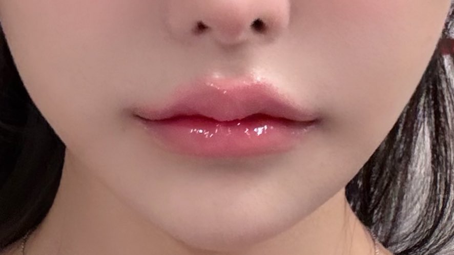 llqy_y's tweet photo. 2年前の元の唇は右で
ここから抜歯矯正と唇ヒアル、口角ボトックスでこんなに変わったよ😭✨ https://t.co/rEwGzEFFbA