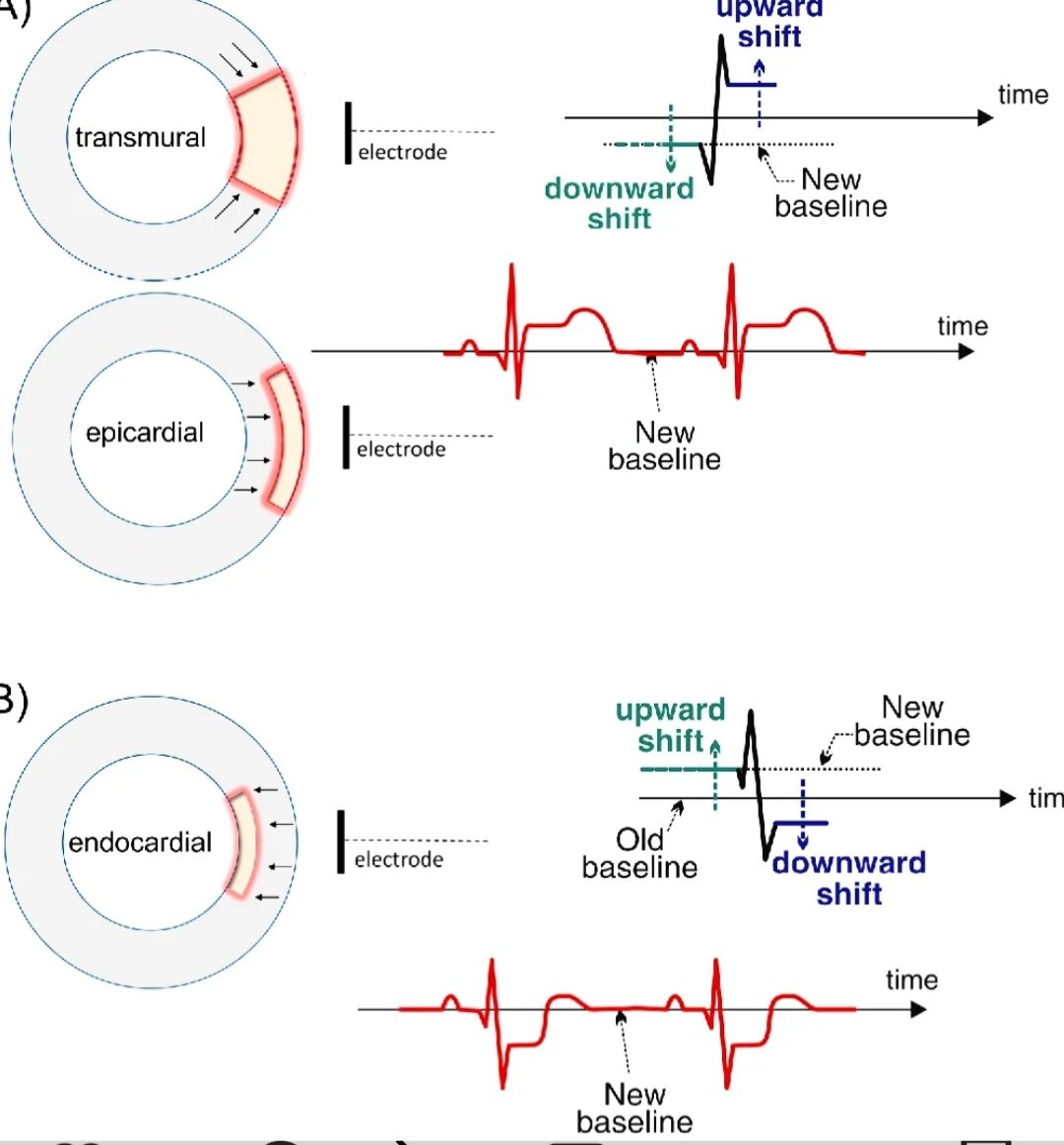 drsthanus's tweet photo. The image illustrates the electrophysiological basis for ST-segment shifts observed in an  ECG)l during myocardial ischemia, specifically in transmural, epicardial, and endocardial injuries. 

https://t.co/Y6SUigP3QG https://t.co/Q7z2oZijEk