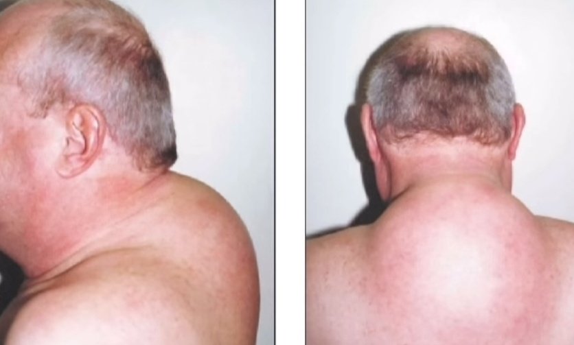 nervemed's tweet photo. What is the most likely diagnosis❓

A. Cushing's Syndrome
B. Hypothyroidism
C. Addison's Disease
D. Acromegaly https://t.co/2gGChPJCd9