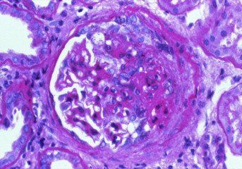AJKDonline's tweet image. #RenalPath: C1q nephropathy w. segmental sclerosis w. increased mesangial matrix, obliteration of capillary lumens, adhesion to Bowman capsule (right half of tuft) Open left portion of glomerulus shows mild to moderate increase in mesangial cellularity 

bit.ly/3XadOLx