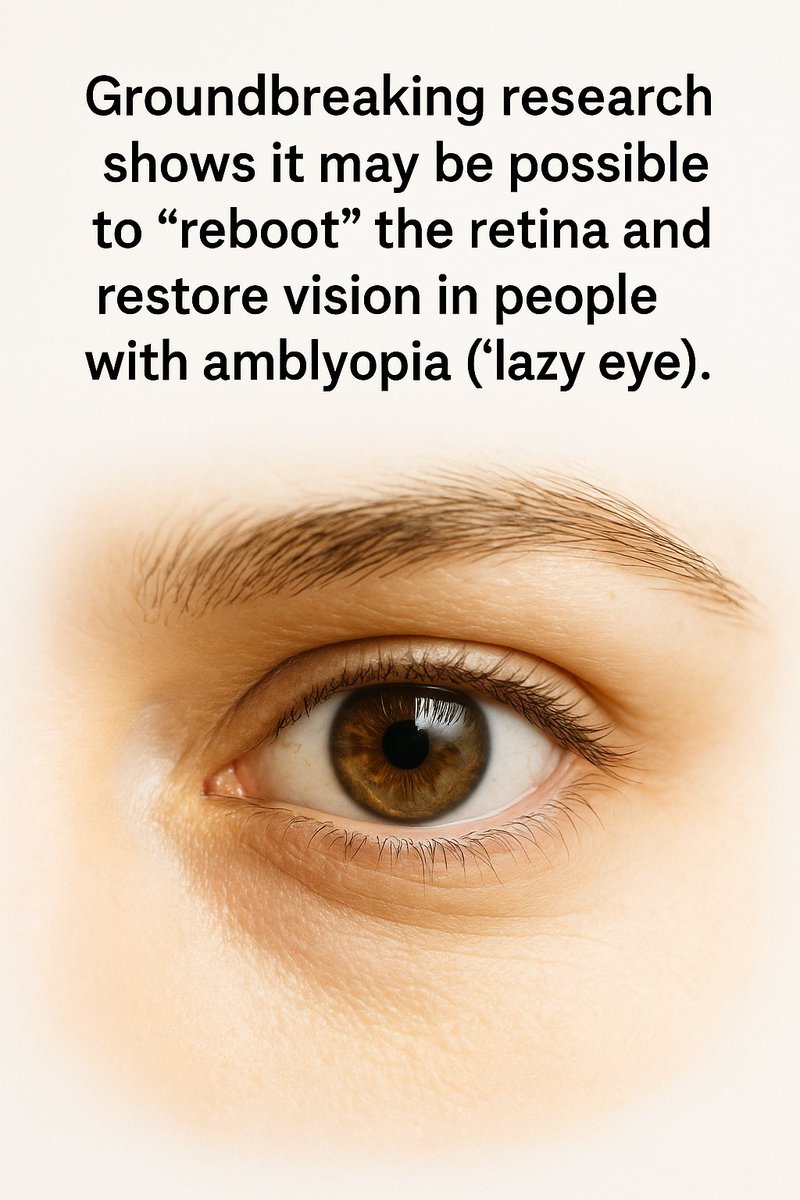 Dr_Singularity's tweet photo. This is amazing

Scientists may have found a way to restore vision in people with amblyopia ("lazy eye") by effectively rebooting the retina and pushing it back into a youthful, self repairing state.

A team at MIT discovered that briefly anesthetizing the retina can reset the visual system’s development, allowing the brain to re establish normal connections, even in adults. 

Amblyopia occurs when, during childhood, the brain suppresses input from one eye, and current treatments only work early in life while neural circuits are still forming.

In the new study, published in Cell Reports, researchers showed that a couple of days of retinal anesthesia in adult mice restored normal visual responses from the previously ignored eye. 

The next steps are to test the method in other animal, and ultimately explore whether the same "retinal reboot” could help human patients regain vision.
