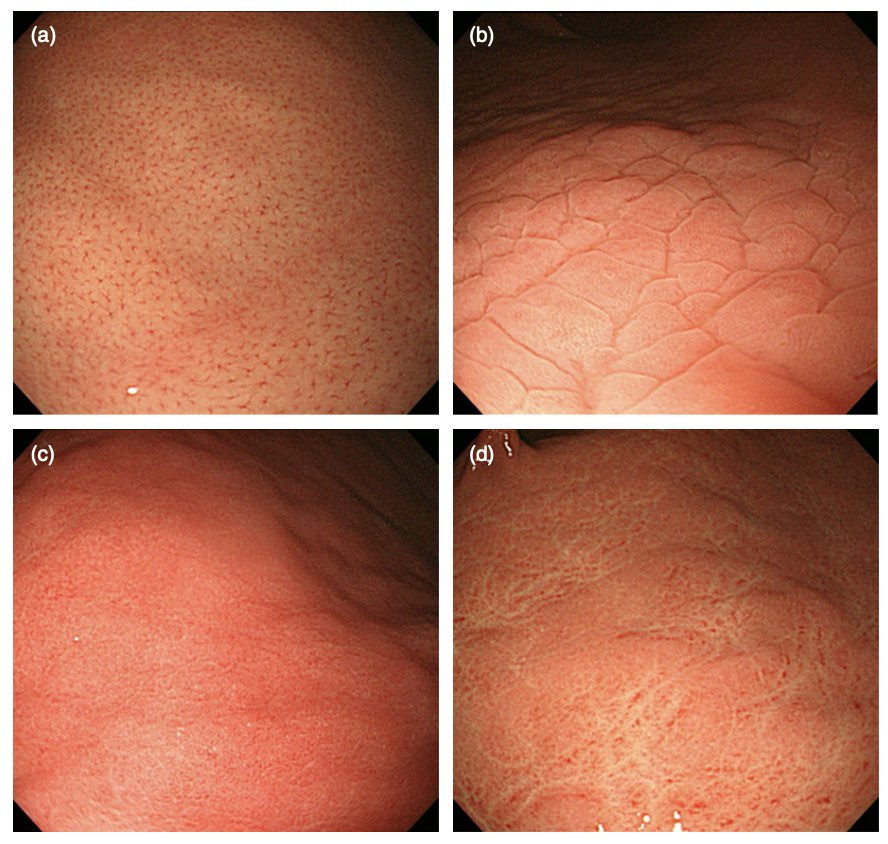 JSebastianPA's tweet photo. Normal and three types of abnormal mucosal patterns in the gastric corpus observed by non-magnifying standard endoscopy. 

(a) Normal, RAC
(b) Mosaic-like or snake skin appearance
(c) Diffuse homogenous redness
(d) Untypical pattern showing irregular redness with groove https://t.co/5XsZKBdKLG