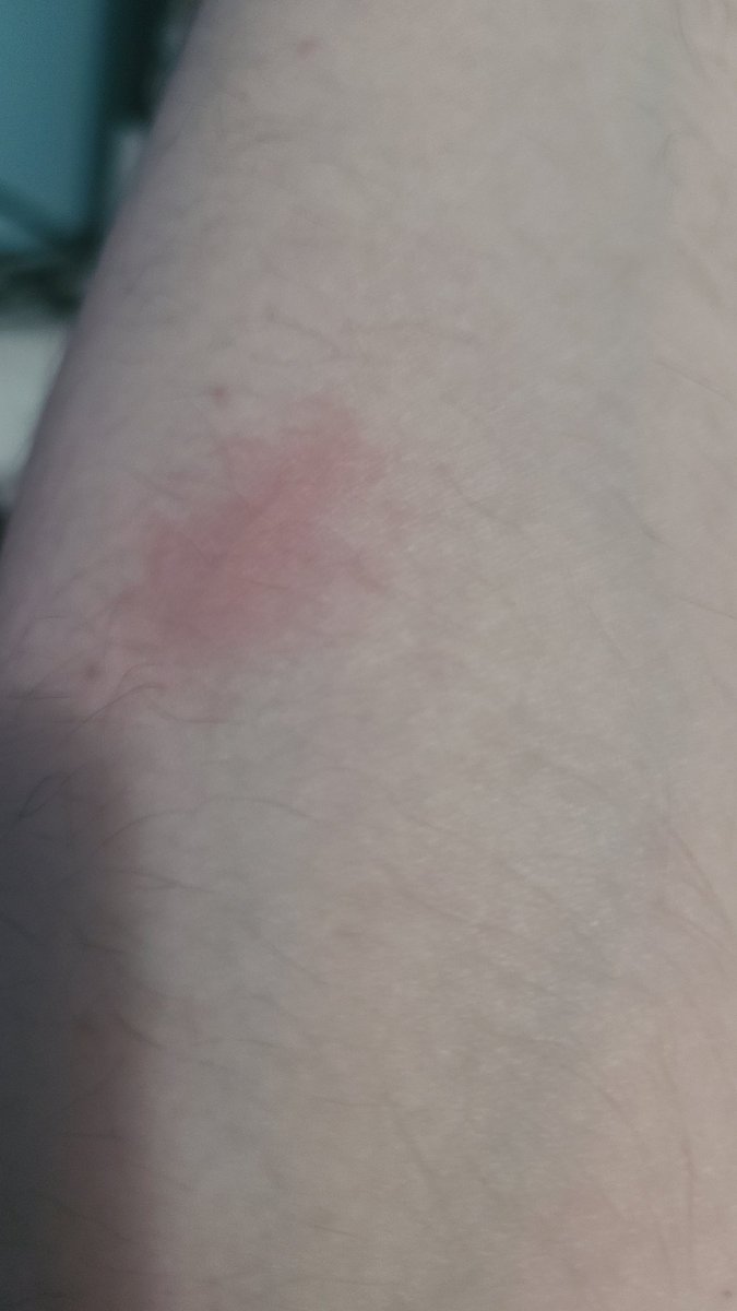 ThatSlimeBot's tweet image. Owie

I burnt myself on a kettle whilst trying to make Hot Chocolate ;w;