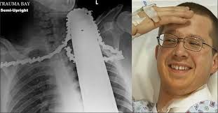 medob_2's tweet image. Em 2014 James Valentine estava cortando uma árvore com uma serra elétrica, e até aí tudo bem. A Serra deu um &quot;rebote&quot; e voltou no pescoço de James. Ela ficou cravada no pescoço dele. Os amigos dele levaram ele para o hospital com a Serra no pescoço e James conseguiu sobreviver!