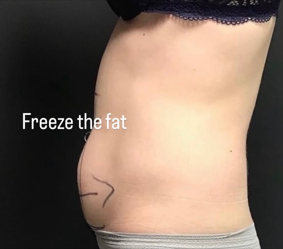 EekhoffMarci's tweet photo. @PowerBruteHQ Coolscuplting- No Surgery! No Downtime!
Reduce those pesky bulges that diet and exercise can’t. https://t.co/4pNWrkXgJG